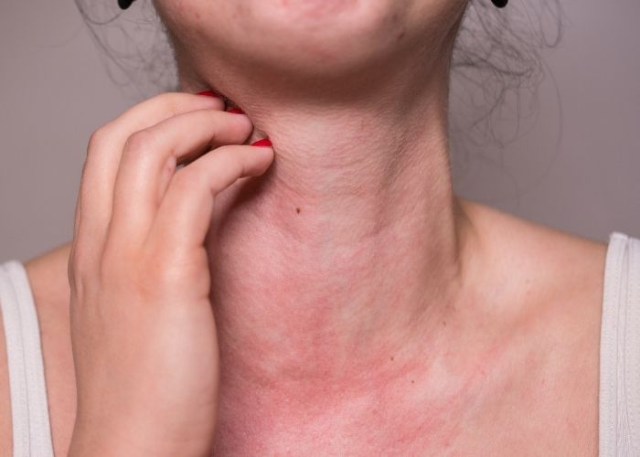 Medication Reaction Needs Immediate Care